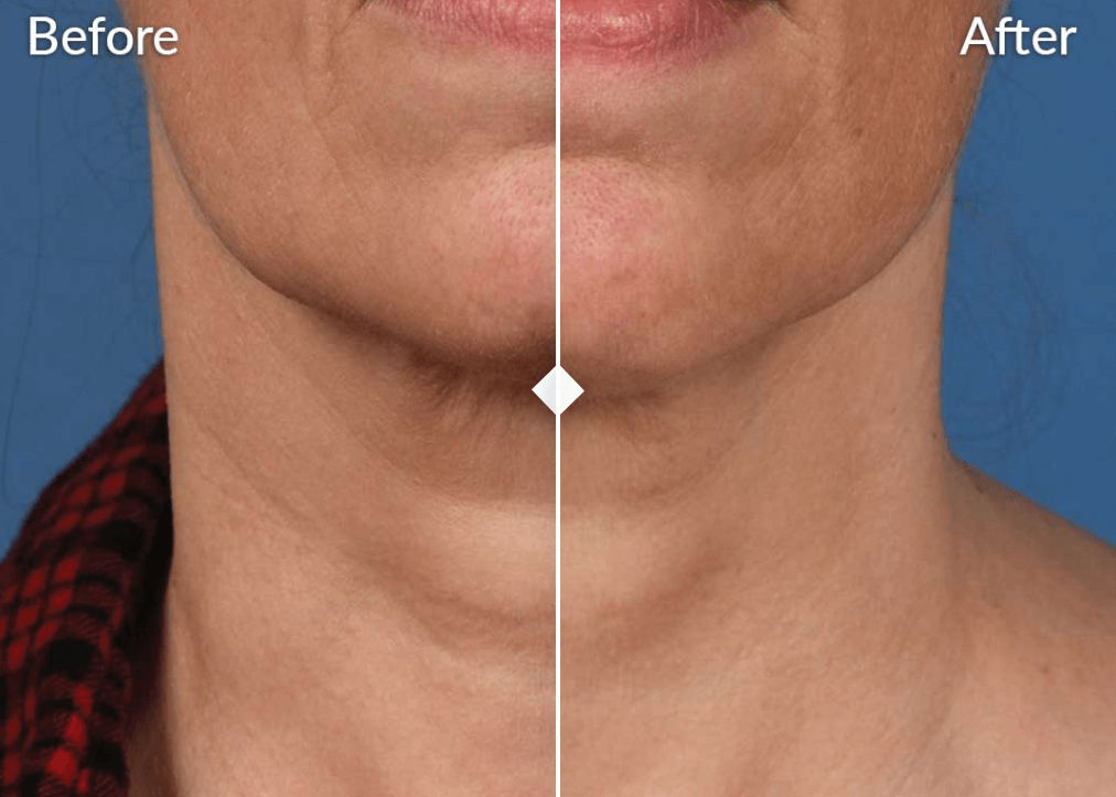 Neck LinesBA
